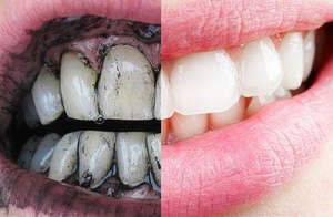 Como branquear os dentes em casa