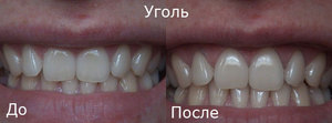 Dentes branqueamento - foto antes e depois