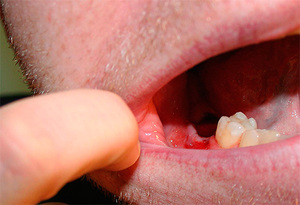 Causas e complicações do orifício não curativo após a extração do dente do siso