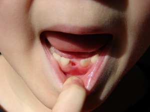 O tempo de cicatrização dos buracos dos dentes removidos