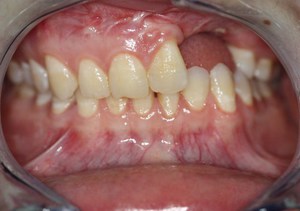 Causas e sintomas de alveolite após extração dentária
