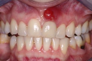 Antibióticos para o fluxo