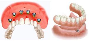 Próteses dentárias