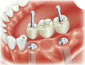 Como é a prótese dentária?
