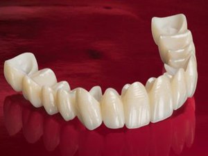 Dentaduras e seus tipos