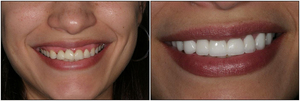 Fotos de folheados nos dentes Folheados montados nos dentes