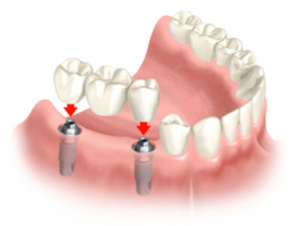 Vantagens dos implantes