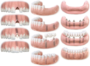 Tipos de implantes