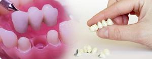 Como estar com a perda de dentes