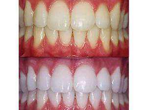 Que manchas de dentes são fáceis de limpar.