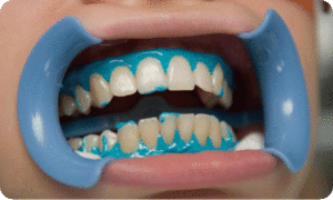 Processo de clareamento dos dentes