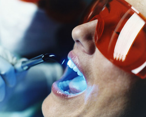 Dentes branqueamento tecnologia