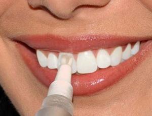 Clareamento dos dentes